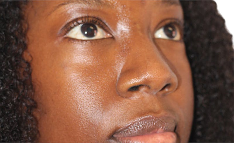 Scar Care Before & After Gallery - Patient 392892 - Image 2