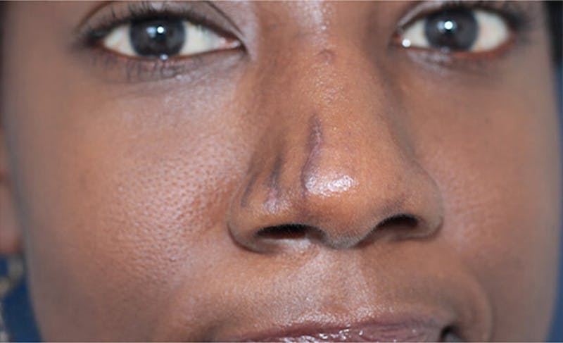 Scar Care Before & After Gallery - Patient 392892 - Image 3