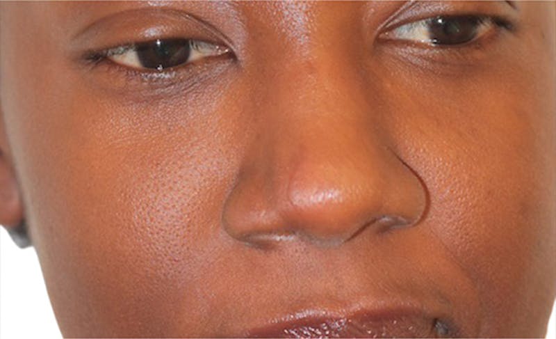 Scar Care Before & After Gallery - Patient 392892 - Image 4