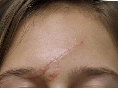 Scar Care Before & After Gallery - Patient 334234 - Image 1