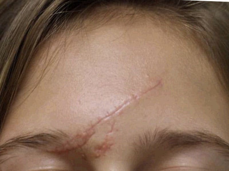 Scar Care Before & After Gallery - Patient 334234 - Image 1