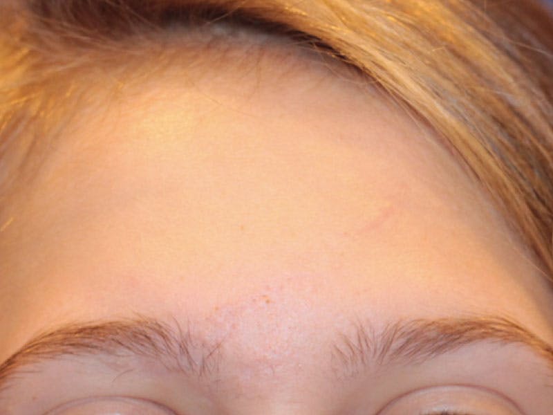 Scar Care Before & After Gallery - Patient 334234 - Image 2