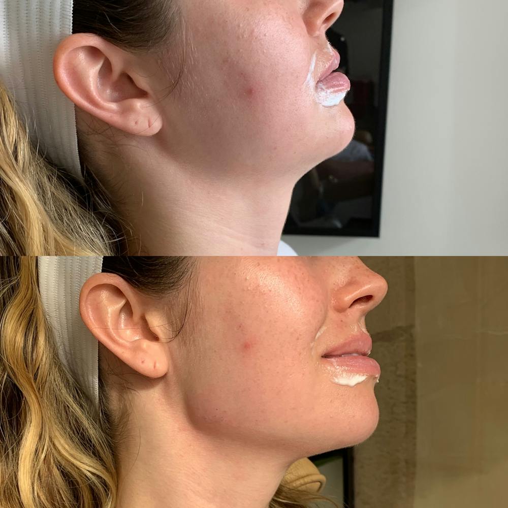 Perk Plastic Surgery after jawline definition treatment