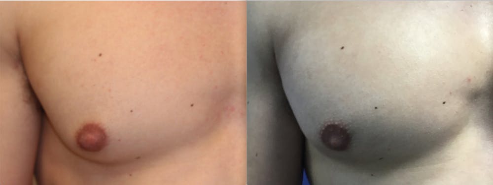 before and after gynecomastia surgery