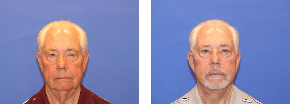 Perk Plastic Surgery patient before and after neck lift