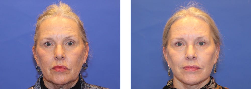 Perk Plastic Surgery patient before and after treatment