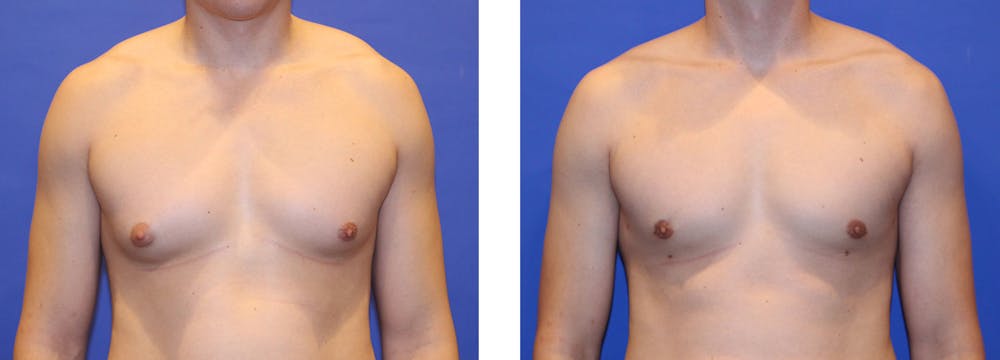 Perk Plastic Surgery patient before and after male breast reduction
