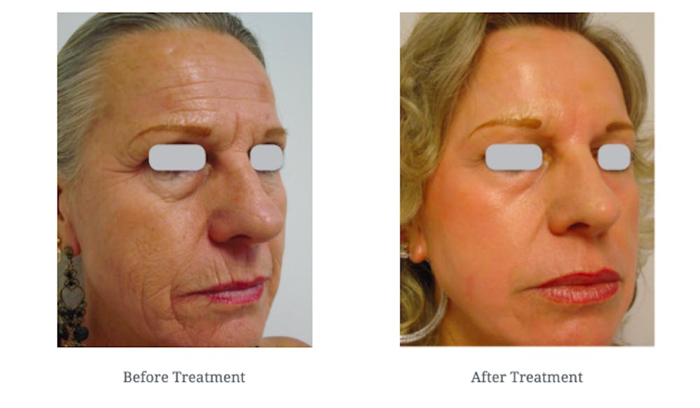 Before and after AcuPulse treatment