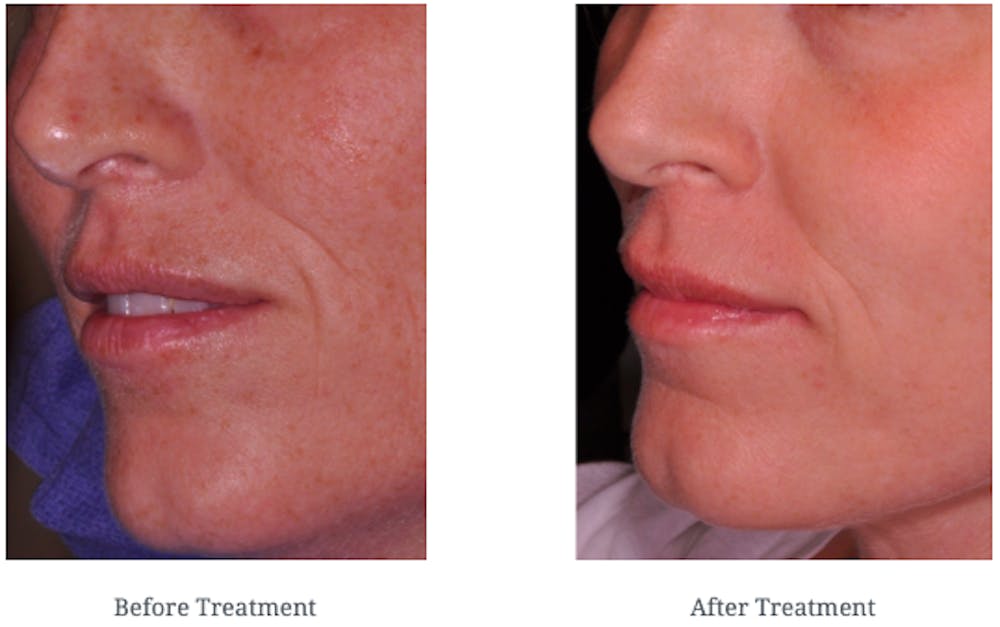 before and after AcuPulse treatment