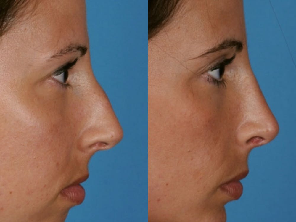 rhinoplasty patient results