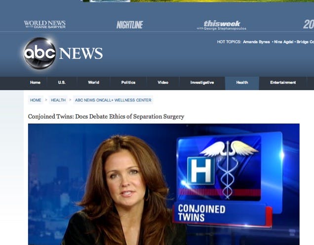 Conjoined Twins: Docs Debate Ethics of Separation Surgery