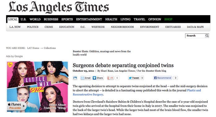 Surgeons Debate Separating Conjoined Twins