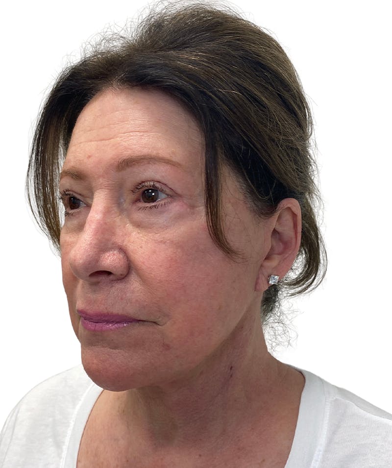 Facelift Before & After Gallery - Patient 403987 - Image 2