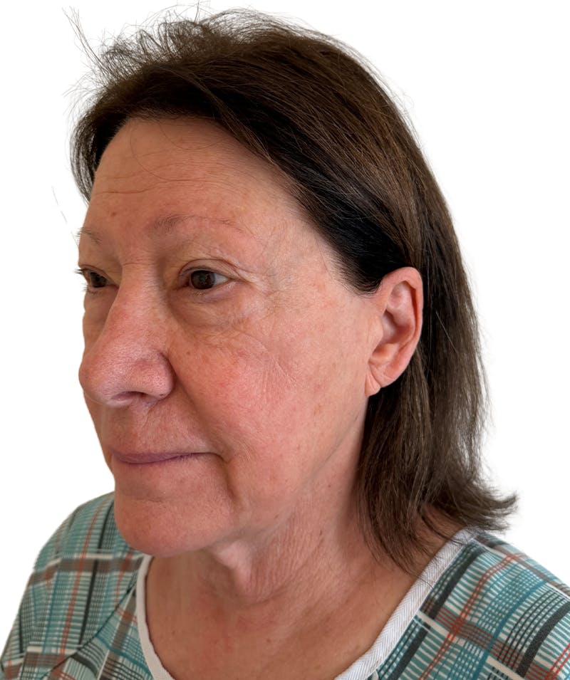 Facelift Before & After Gallery - Patient 403987 - Image 1