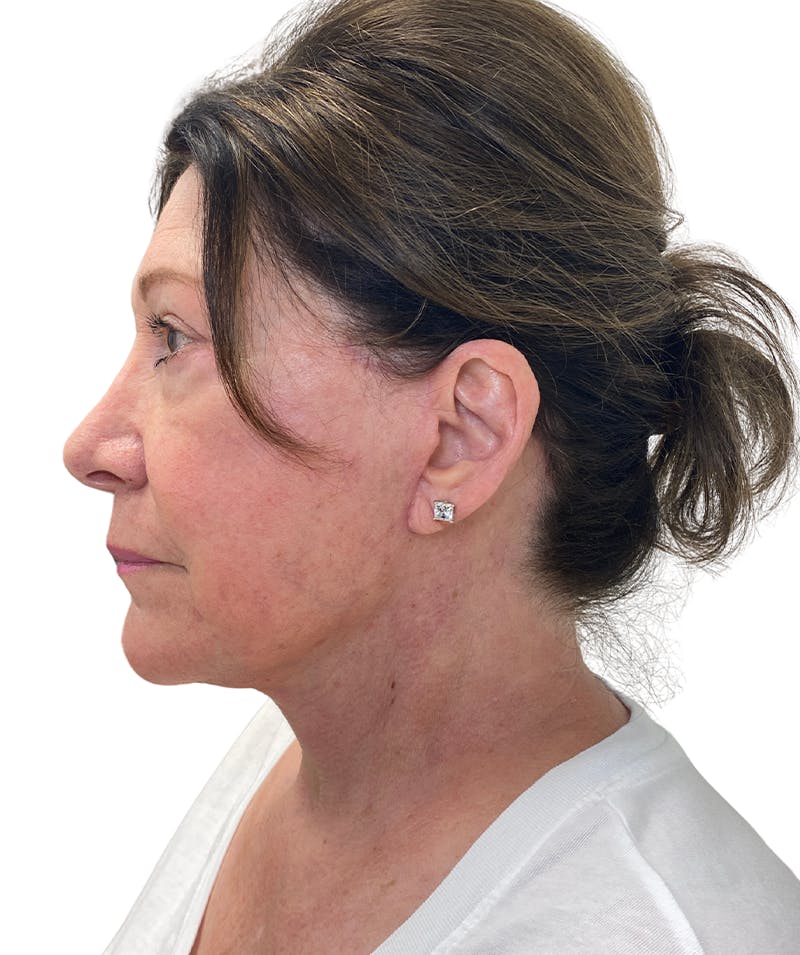 Facelift Before & After Gallery - Patient 403987 - Image 4