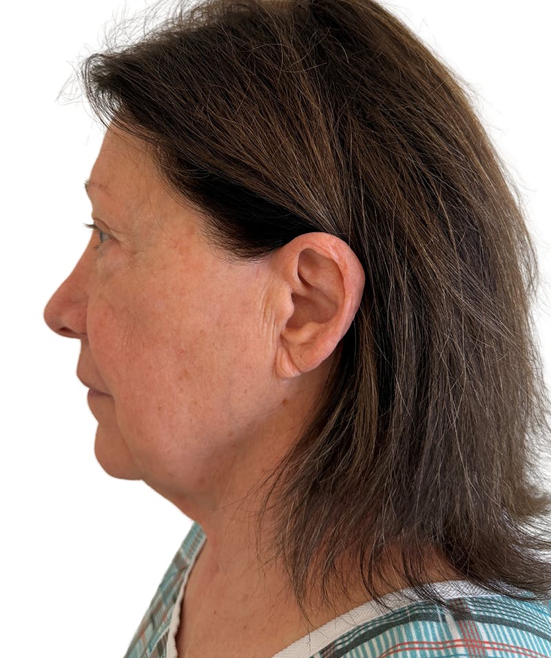 Facelift Before & After Gallery - Patient 403987 - Image 3