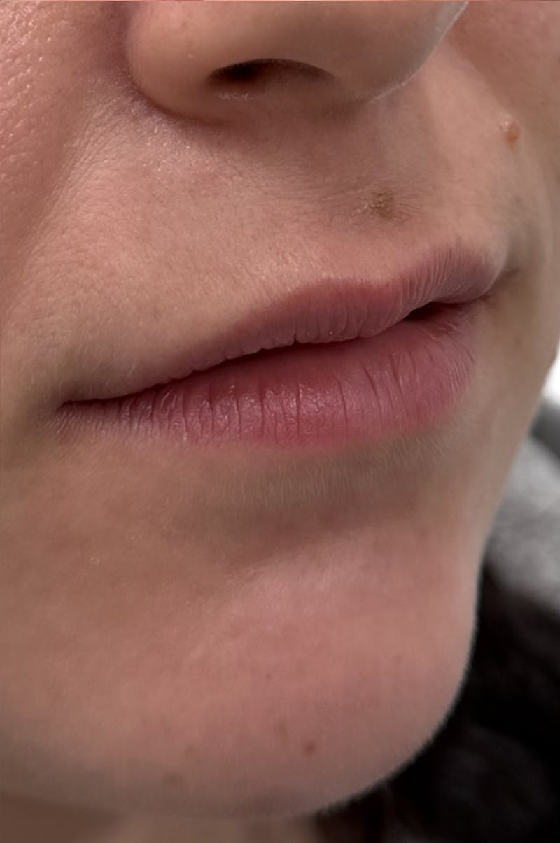 Filler Before & After Gallery - Patient 398953 - Image 1