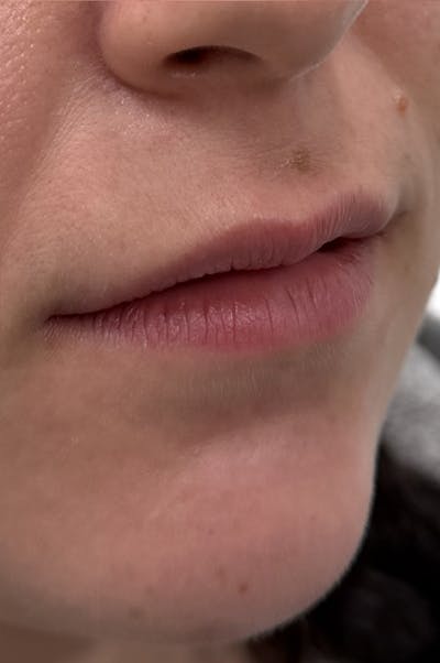 Filler Before & After Gallery - Patient 398953 - Image 1