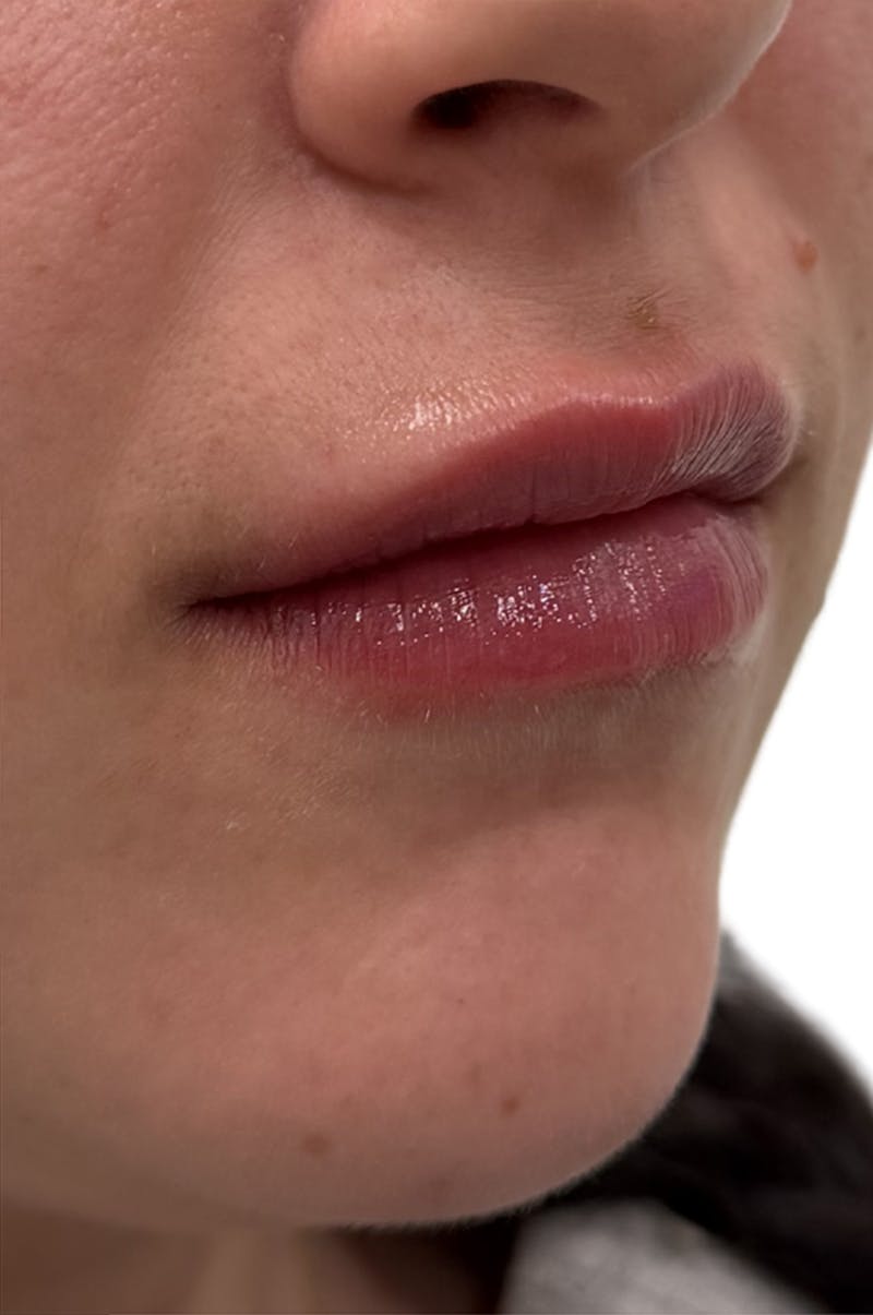 Filler Before & After Gallery - Patient 398953 - Image 2