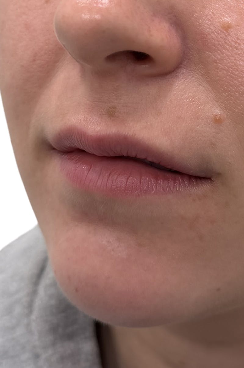 Filler Before & After Gallery - Patient 398953 - Image 3