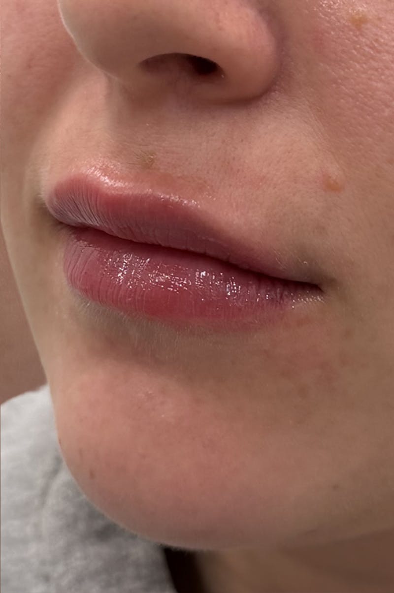 Filler Before & After Gallery - Patient 398953 - Image 4
