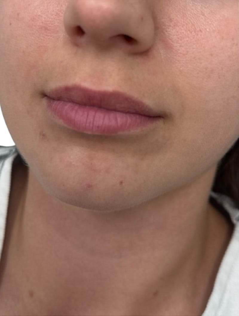 Filler Before & After Gallery - Patient 172943 - Image 1