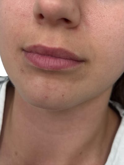 Filler Before & After Gallery - Patient 172943 - Image 1