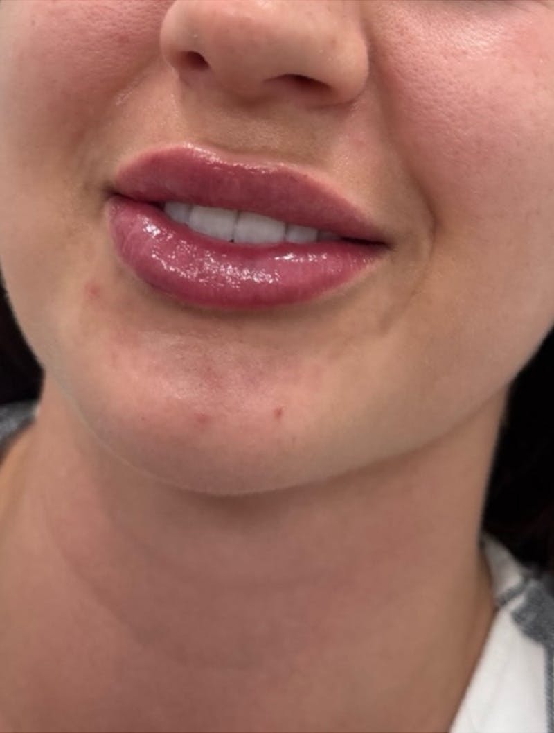 Filler Before & After Gallery - Patient 172943 - Image 2