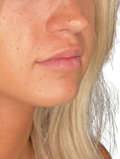Filler Before & After Gallery - Patient 380039 - Image 1
