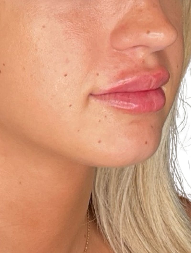 Filler Before & After Gallery - Patient 380039 - Image 2