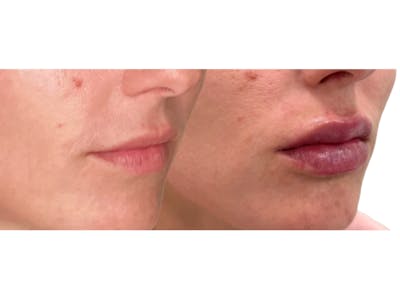 Filler Before & After Gallery - Patient 269636 - Image 1