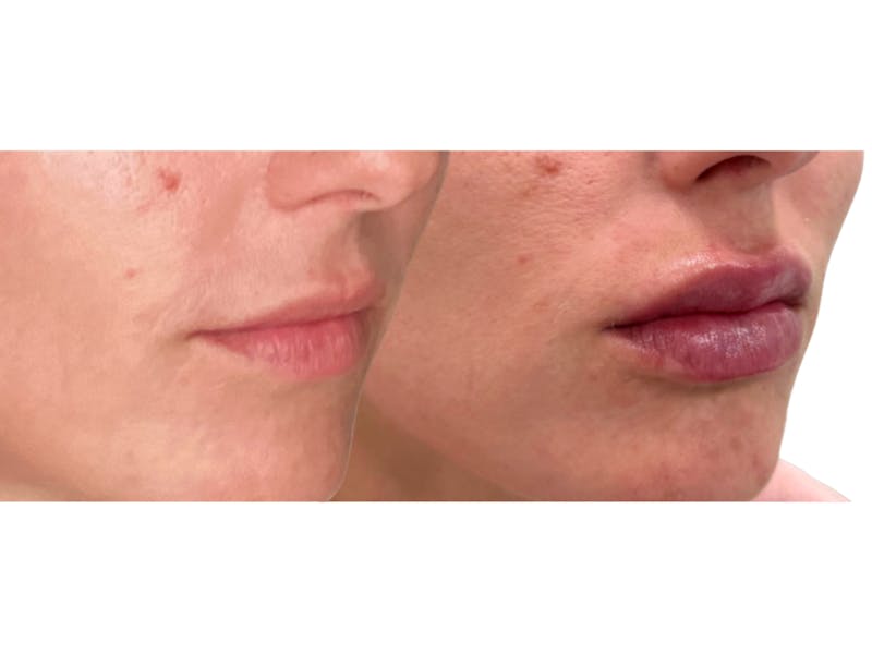 Filler Before & After Gallery - Patient 269636 - Image 1