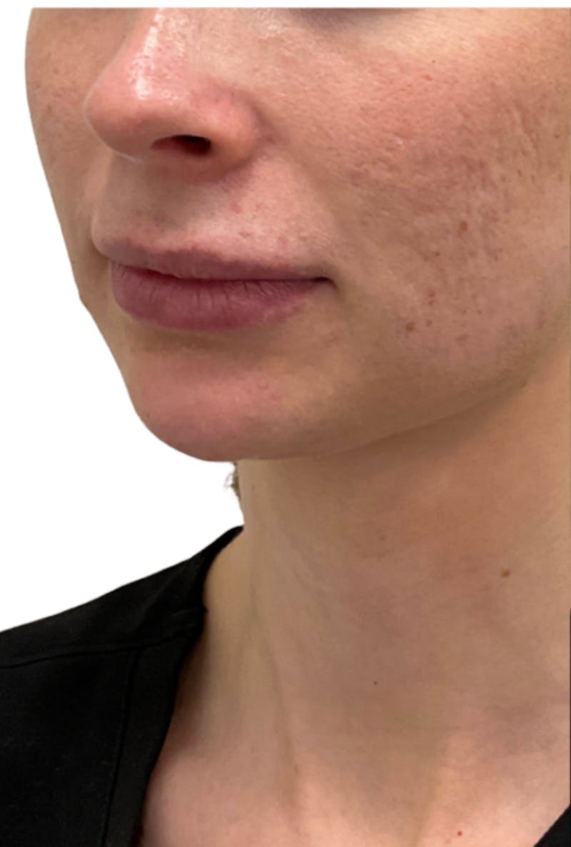 Filler Before & After Gallery - Patient 269636 - Image 2