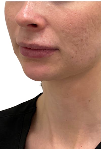 Filler Before & After Gallery - Patient 269636 - Image 2