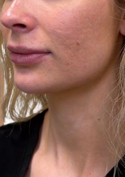 Filler Before & After Gallery - Patient 269636 - Image 1