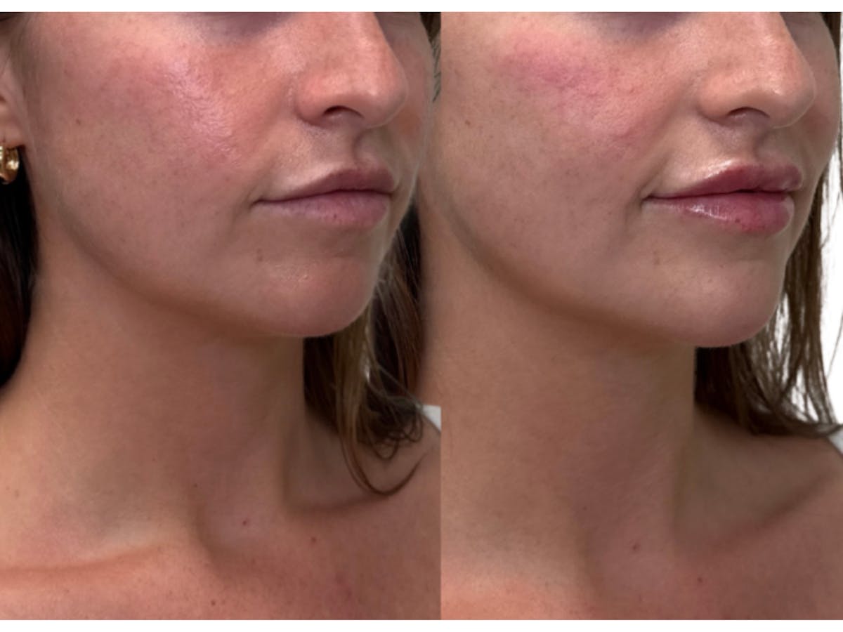 Filler Before & After Gallery - Patient 128813 - Image 2