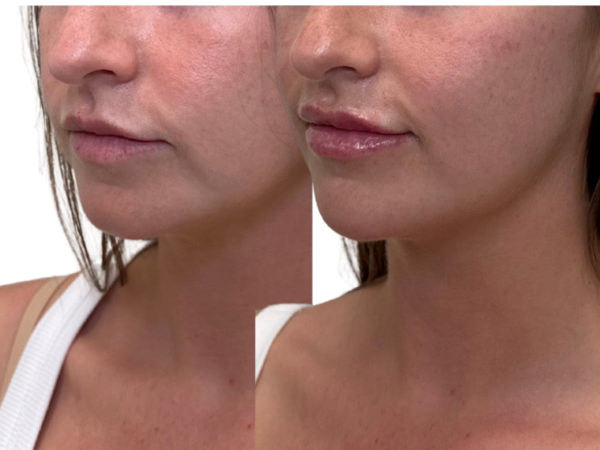 Filler Before & After Gallery - Patient 128813 - Image 1