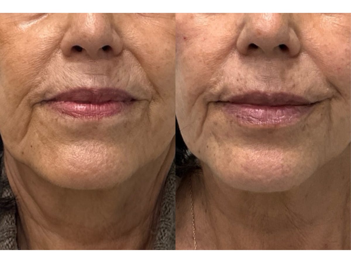 Filler Before & After Gallery - Patient 784492 - Image 1