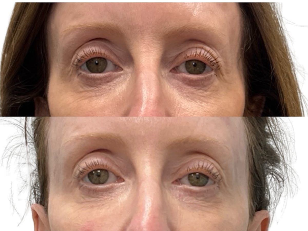 Filler Before & After Gallery - Patient 118187 - Image 1