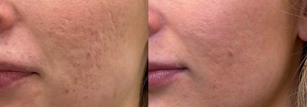 Skin Transformation Before & After Gallery - Patient 183336 - Image 1