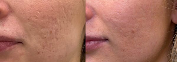 Skin Transformation Before & After Gallery - Patient 183336 - Image 1