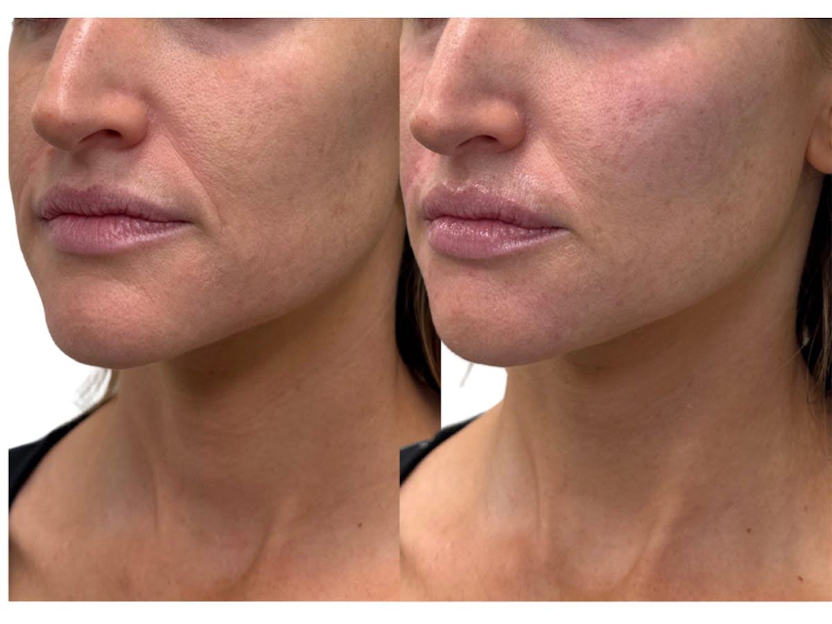 Filler Before & After Gallery - Patient 470619 - Image 1