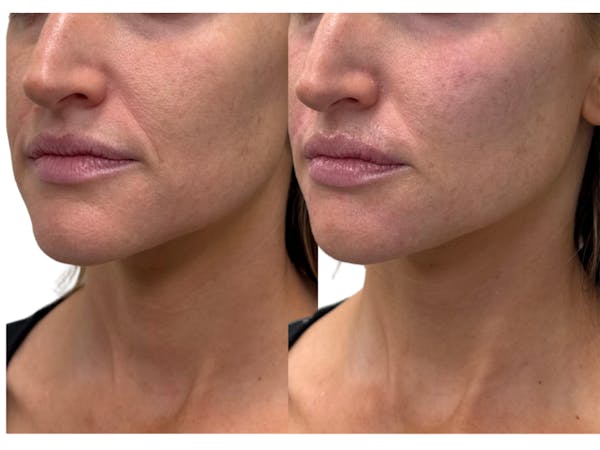 Filler Before & After Gallery - Patient 470619 - Image 1
