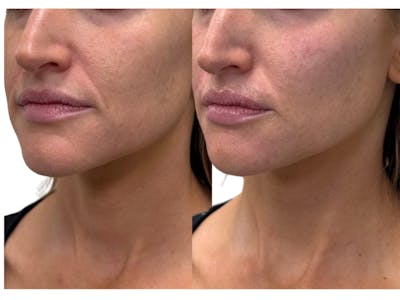 Filler Before & After Gallery - Patient 470619 - Image 1
