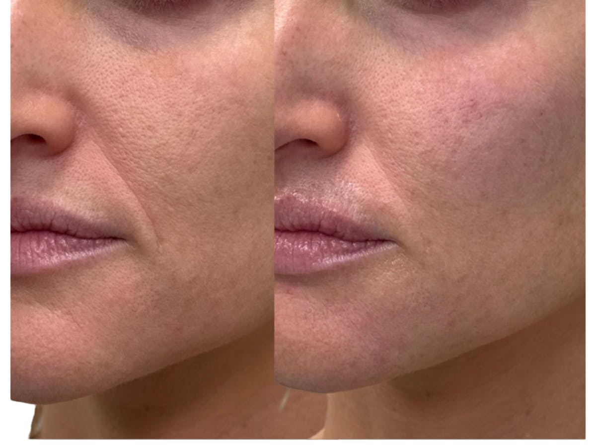 Filler Before & After Gallery - Patient 470619 - Image 2