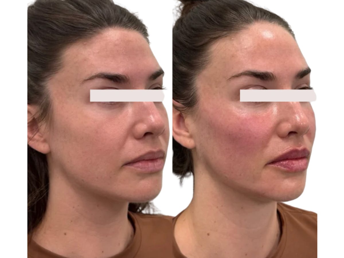 Filler Before & After Gallery - Patient 154290 - Image 1