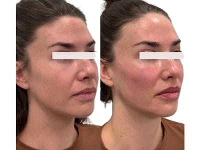 Filler Before & After Gallery - Patient 154290 - Image 1