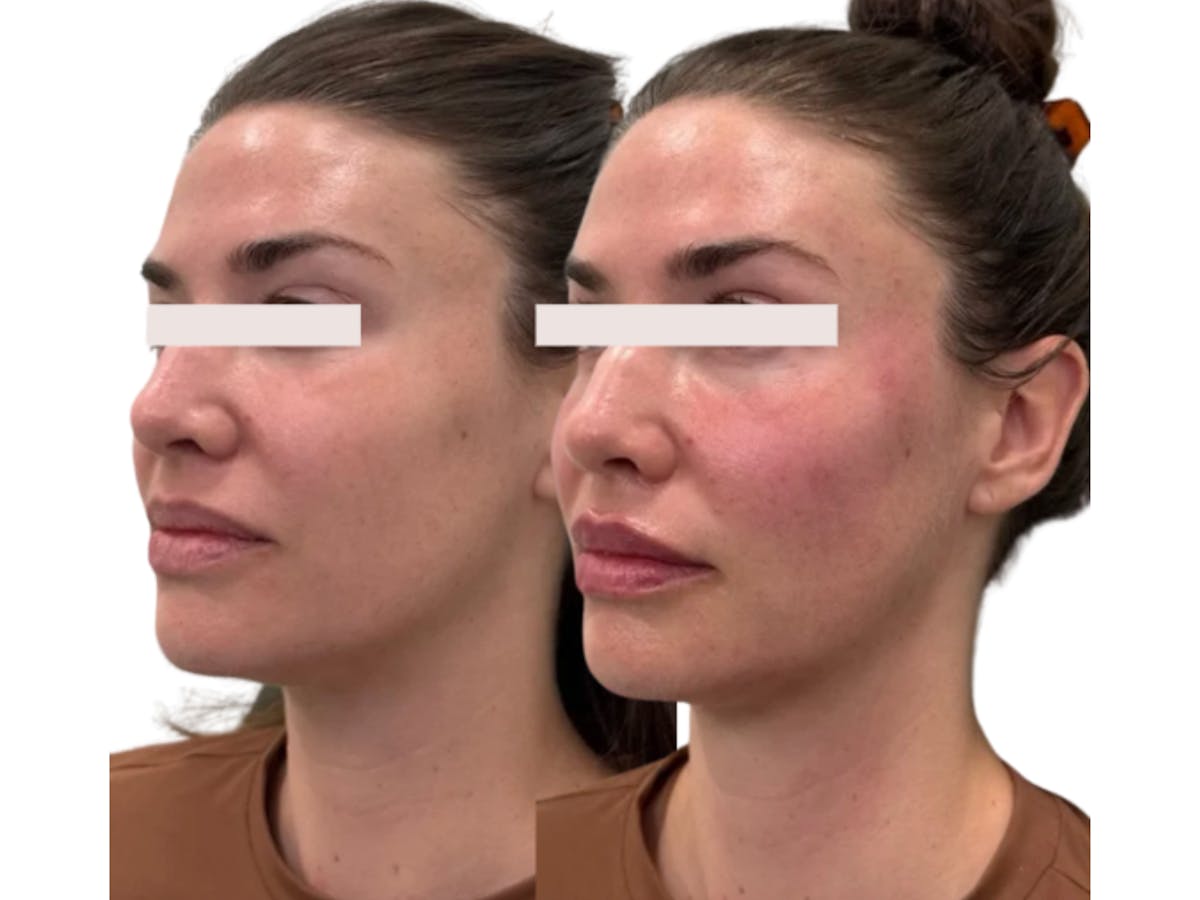 Filler Before & After Gallery - Patient 154290 - Image 2