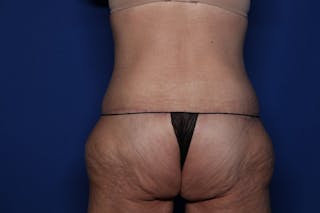 Body Lift Before & After Gallery - Patient 396153 - Image 6