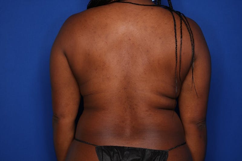 BodyTite™ Before and After Before & After Gallery - Patient 109695 - Image 3